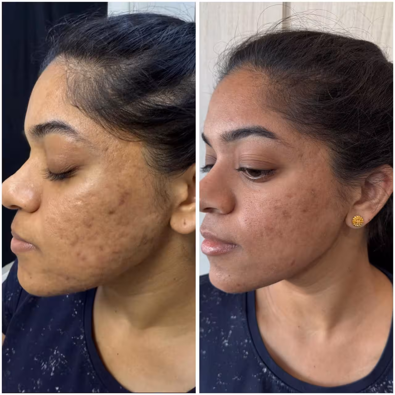 Microneedling with GFC