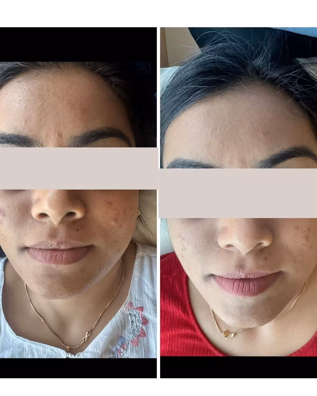 Microneedling with GFC