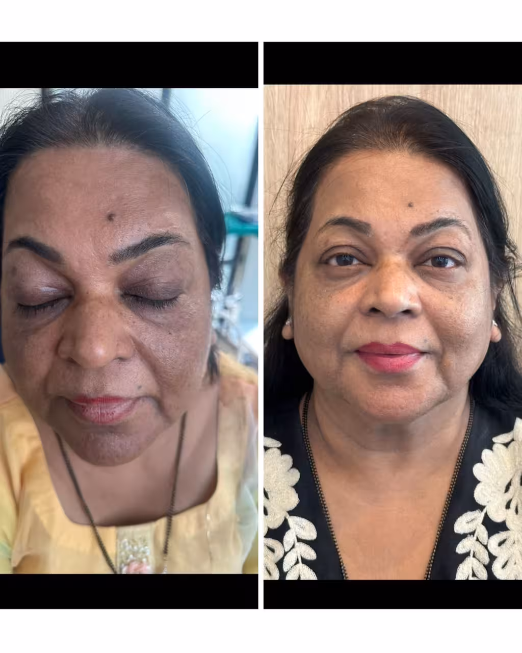 Microneedling with GFC