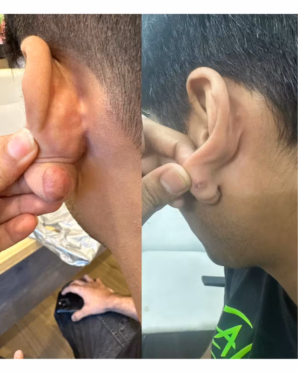Microneedling with GFC
