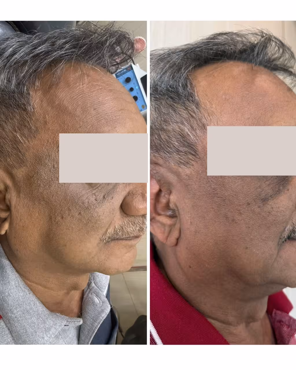 Microneedling with GFC
