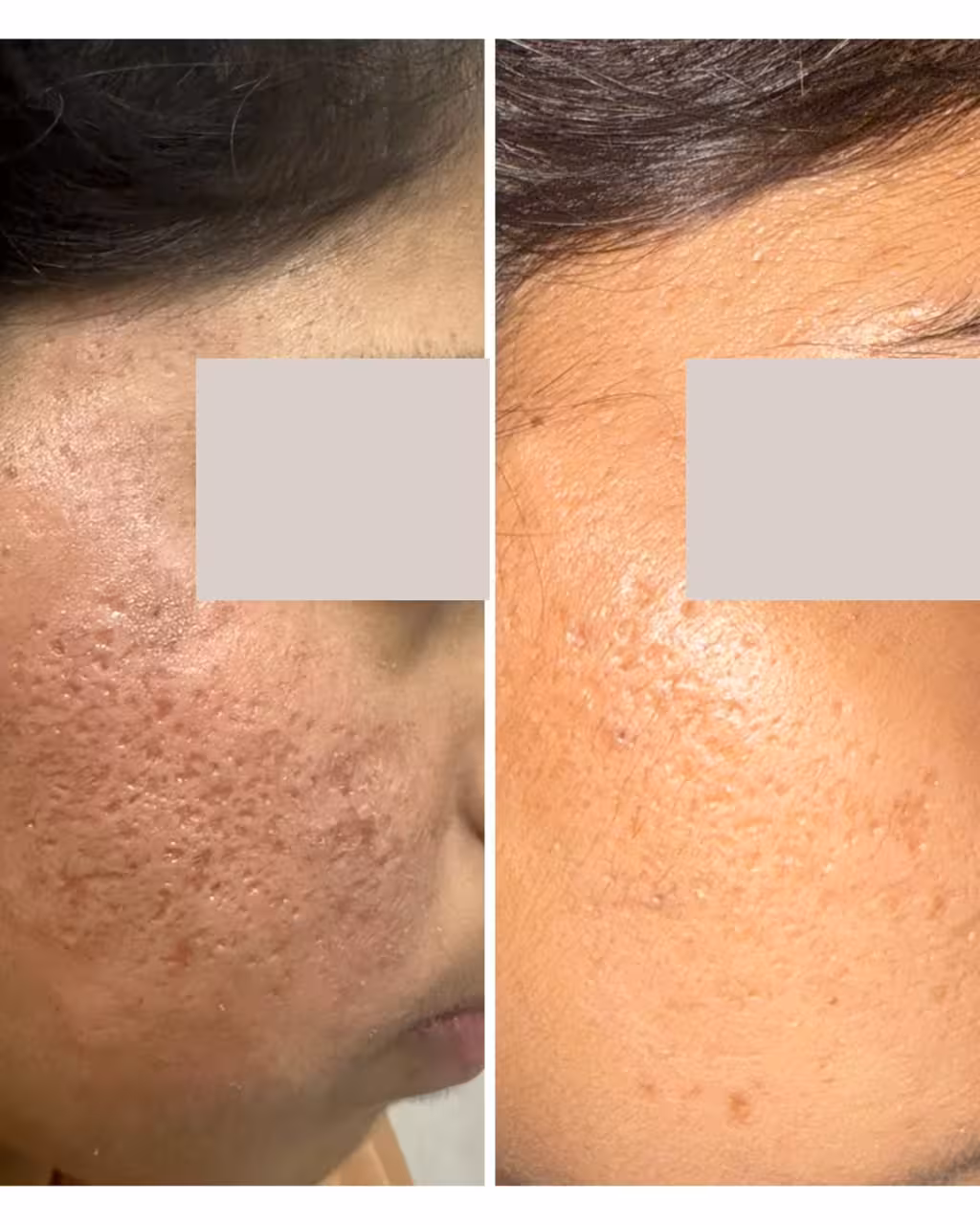 Microneedling with GFC