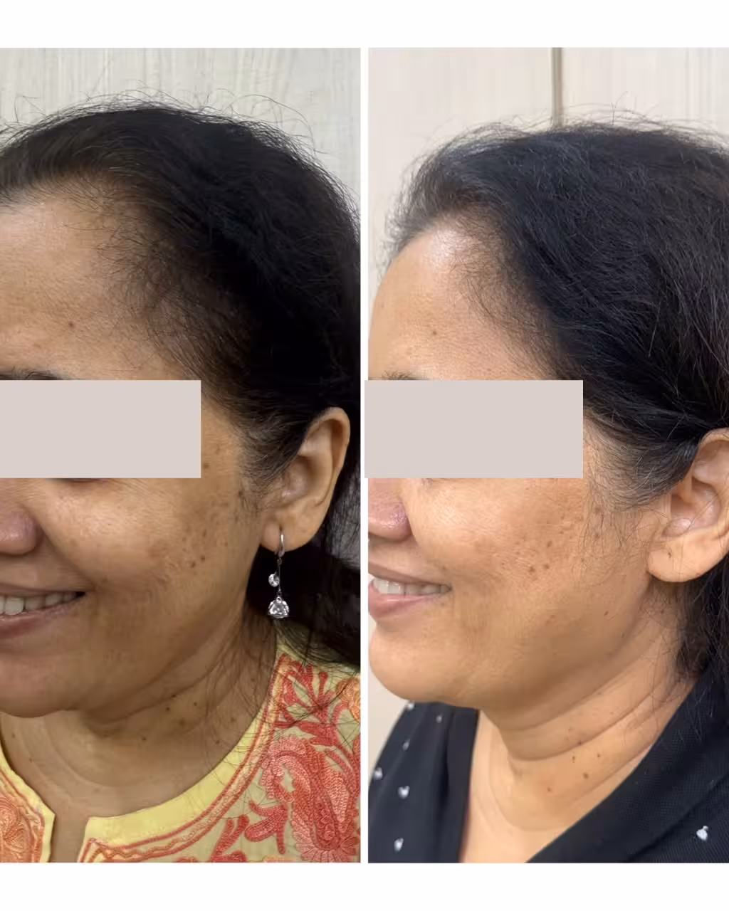 Microneedling with GFC